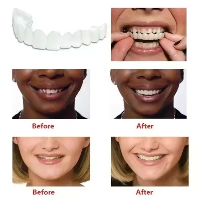 歯のベニア、ホワイトニング、入れ歯、歯列矯正、一時的な義歯カ - Teeth Whitening With Braces のレビューと価格
