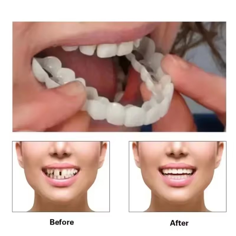 歯のベニア、ホワイトニング、入れ歯、歯列矯正、一時的な義歯カ - Teeth Whitening With Braces のレビューと価格