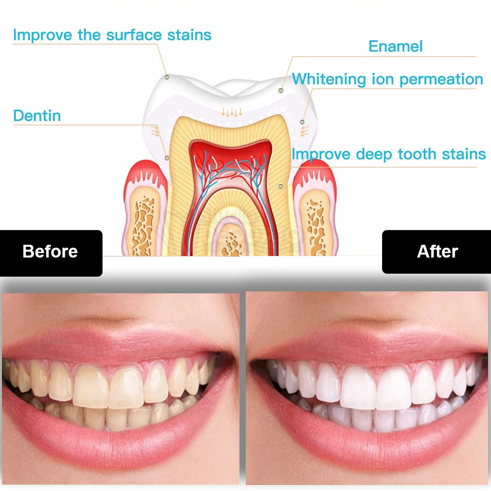 歯科歯ホワイトニングキットミニ 16 LED コールドライト - Teeth Whitening Led Kit のレビューと価格