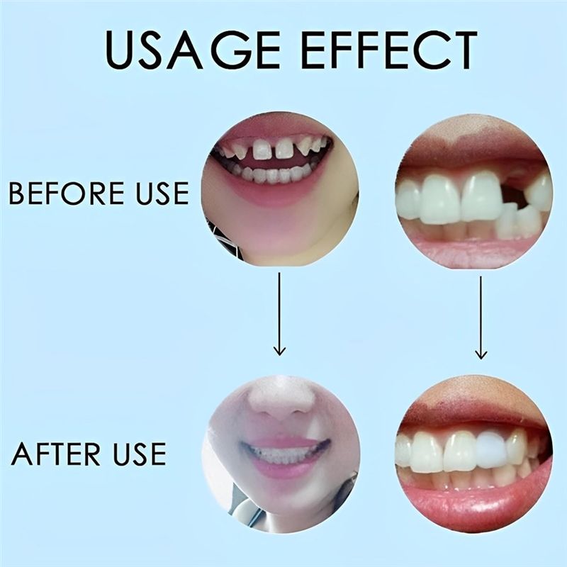 【新商品！ABMK】2ペア、美しい笑顔を取り戻す、ユニバーサ - Teeth Whitening With Braces のレビューと価格